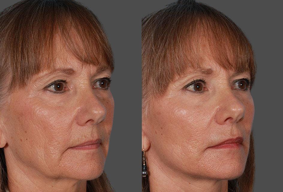 Limited Incision Facelift Before & After Gallery - Patient 227132 - Image 2