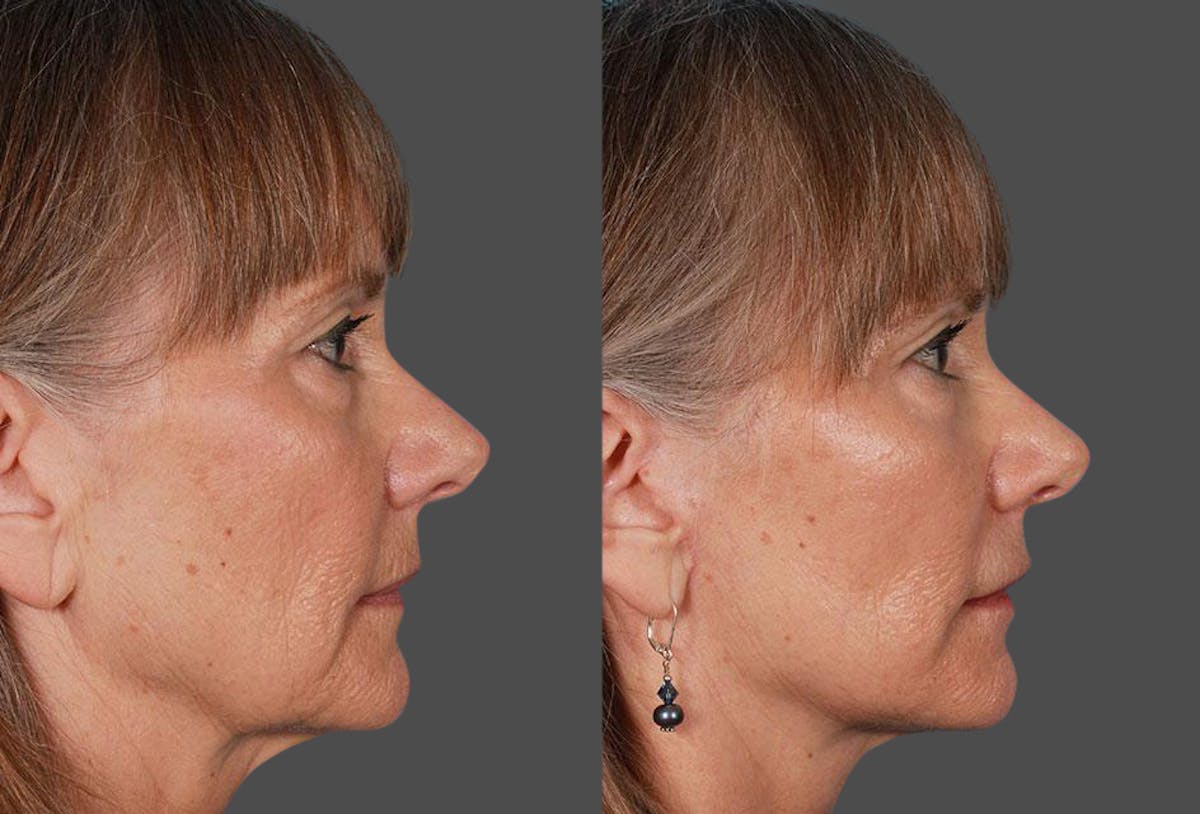 Limited Incision Facelift Before & After Gallery - Patient 227132 - Image 3