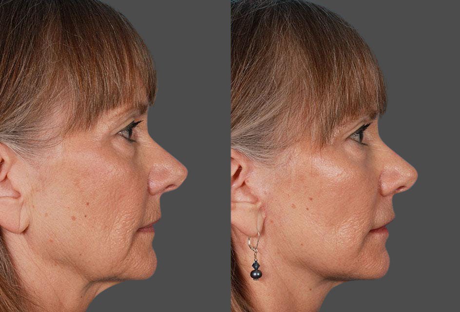 Limited Incision Facelift Before & After Gallery - Patient 227132 - Image 3
