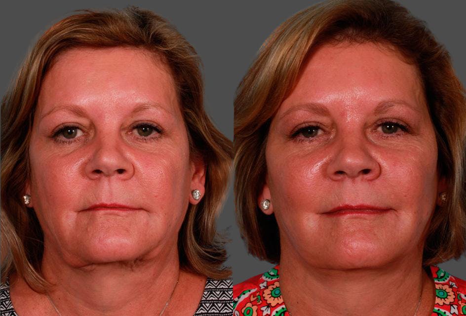 Limited Incision Facelift Before & After Gallery - Patient 221496 - Image 1