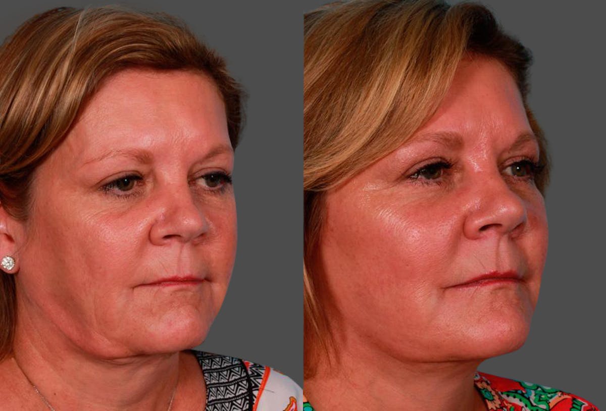 Limited Incision Facelift Before & After Gallery - Patient 221496 - Image 2