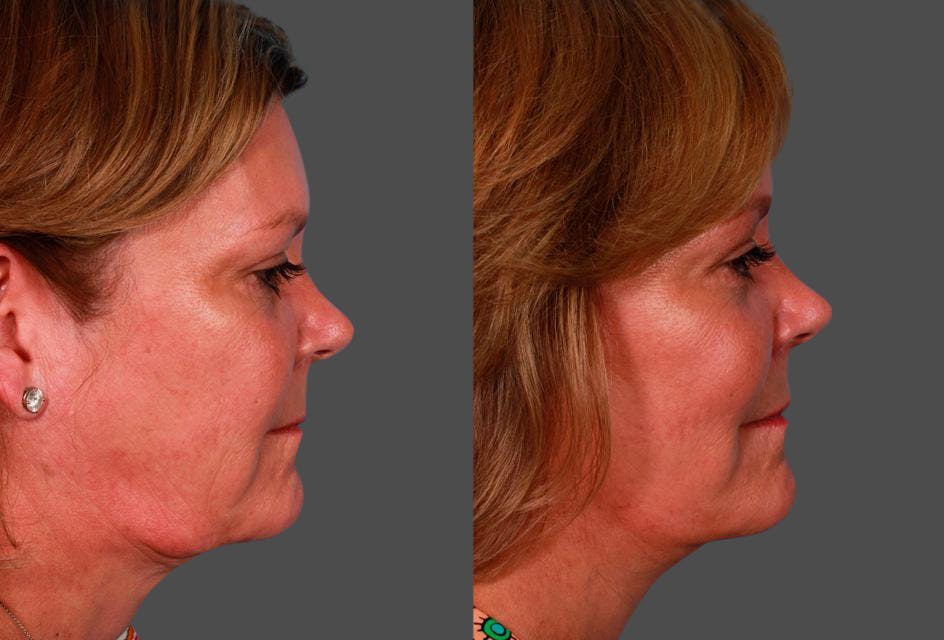 Limited Incision Facelift Before & After Gallery - Patient 221496 - Image 3