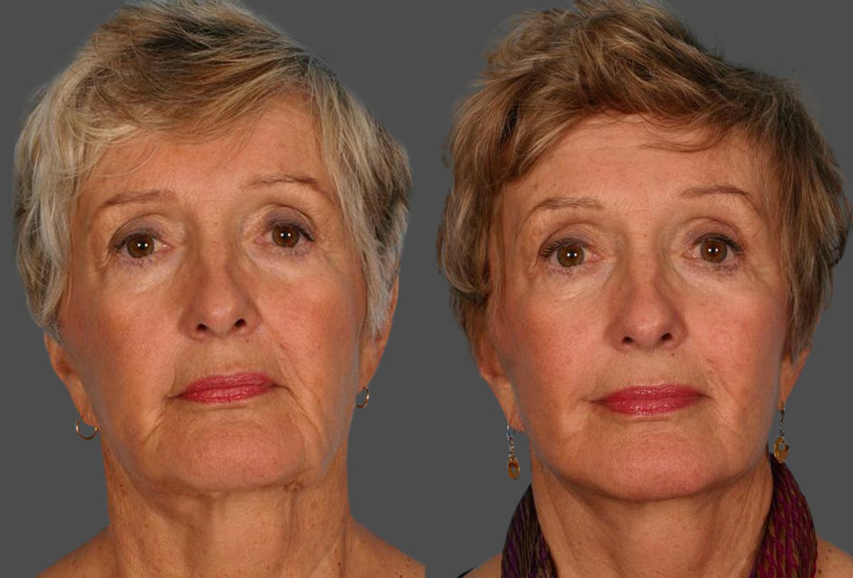 Limited Incision Facelift Before & After Gallery - Patient 143127 - Image 1