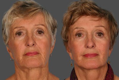 Limited Incision Facelift Before & After Gallery - Patient 143127 - Image 1