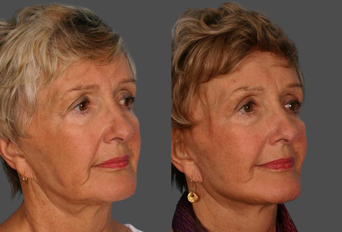 Limited Incision Facelift Before & After Gallery - Patient 143127 - Image 2