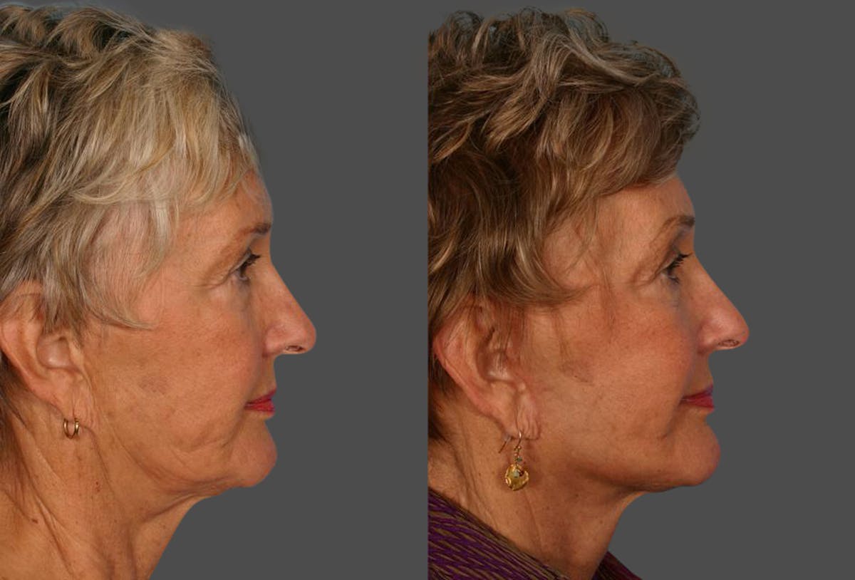 Limited Incision Facelift Before & After Gallery - Patient 143127 - Image 3