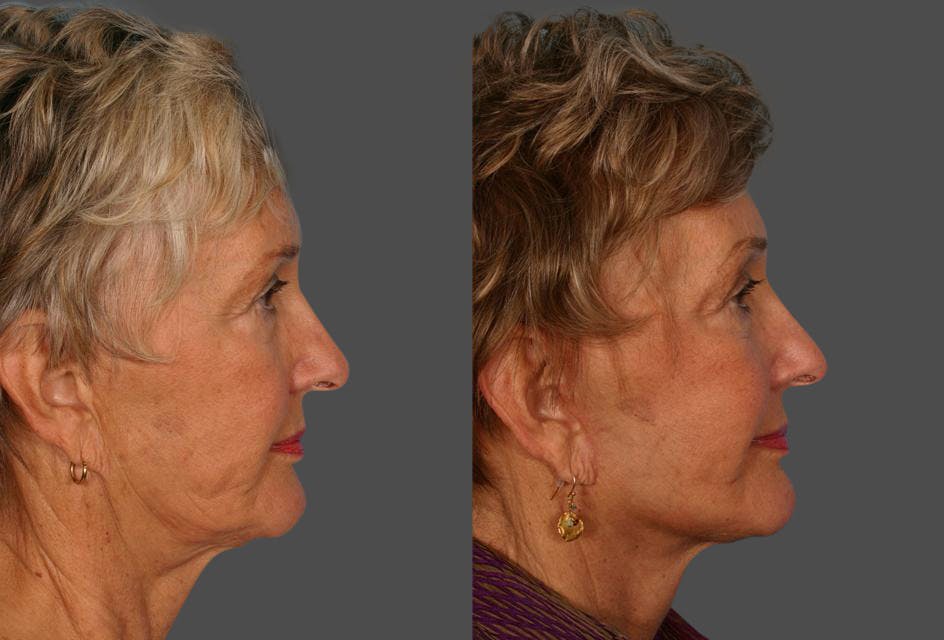 Limited Incision Facelift Before & After Gallery - Patient 143127 - Image 3