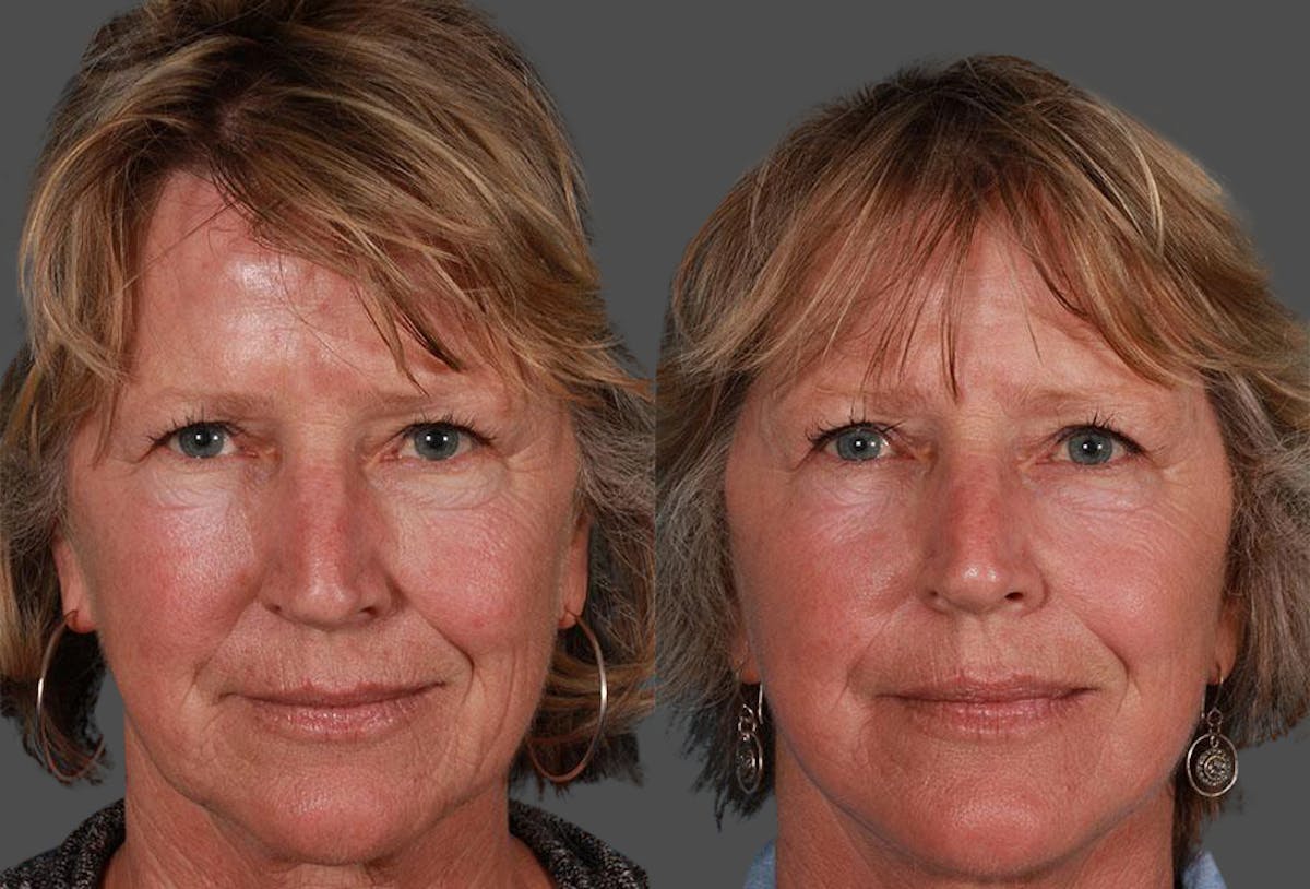 Limited Incision Facelift Before & After Gallery - Patient 130114 - Image 1