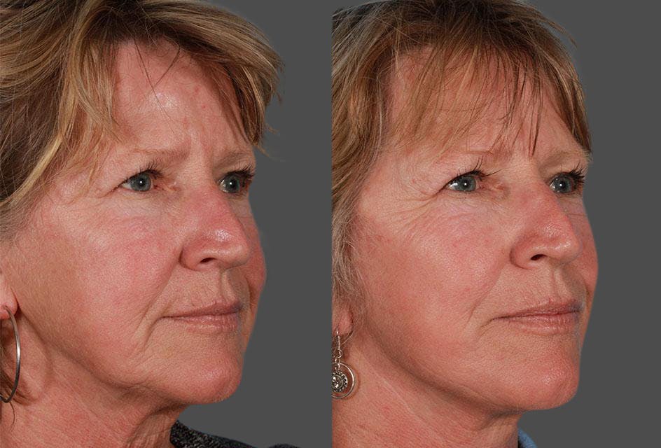 Limited Incision Facelift Before & After Gallery - Patient 130114 - Image 2