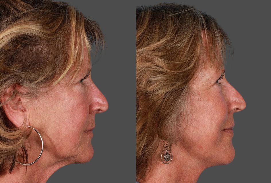 Limited Incision Facelift Before & After Gallery - Patient 130114 - Image 3