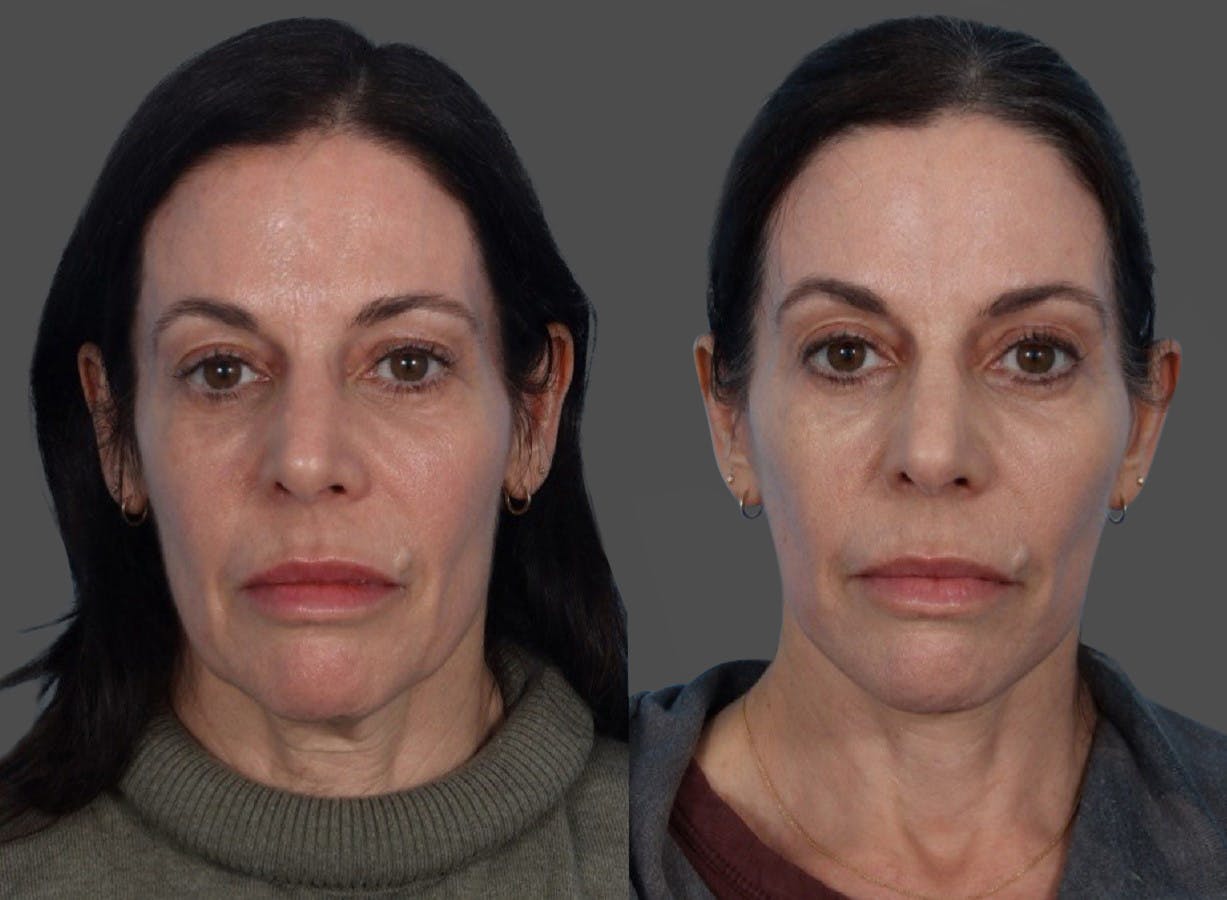 Limited Incision Facelift Before & After Gallery - Patient 408711 - Image 1