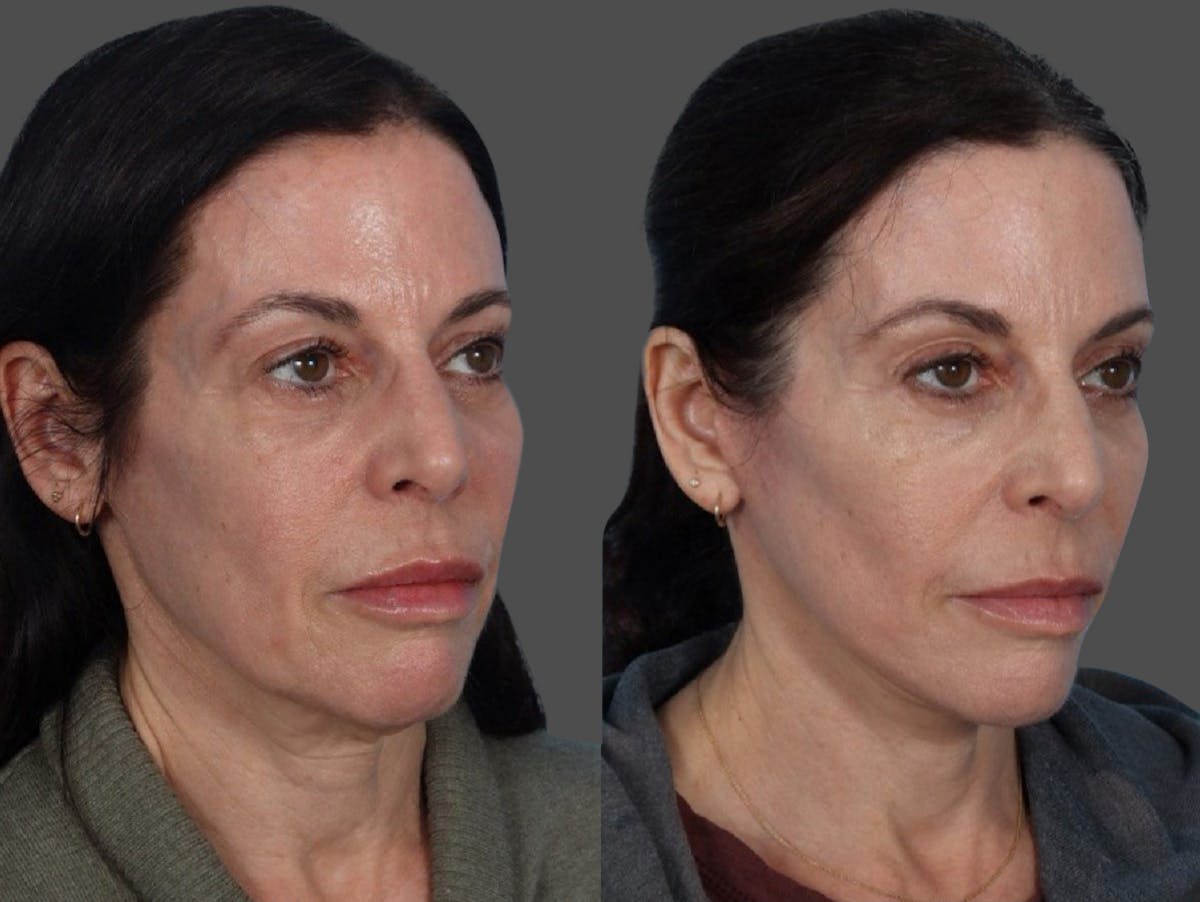 Limited Incision Facelift Before & After Gallery - Patient 408711 - Image 2