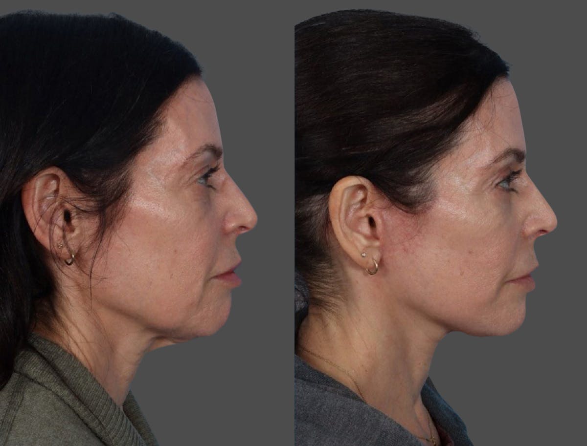 Limited Incision Facelift Before & After Gallery - Patient 408711 - Image 3