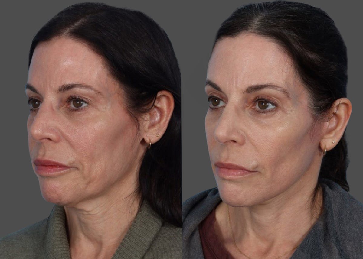 Limited Incision Facelift Before & After Gallery - Patient 408711 - Image 4
