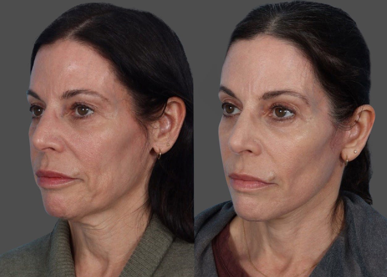 Limited Incision Facelift Before & After Gallery - Patient 408711 - Image 4