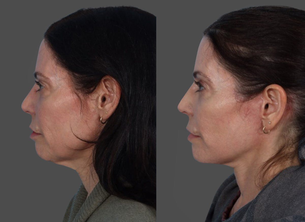 Limited Incision Facelift Before & After Gallery - Patient 408711 - Image 5