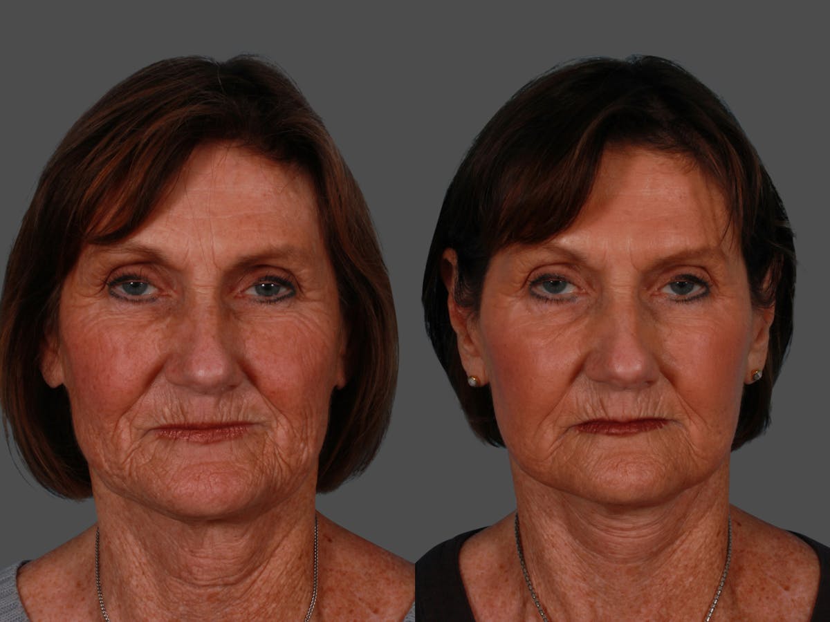 Limited Incision Facelift Before & After Gallery - Patient 583706 - Image 1