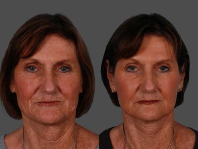 Limited Incision Facelift Before & After Gallery - Patient 583706 - Image 1