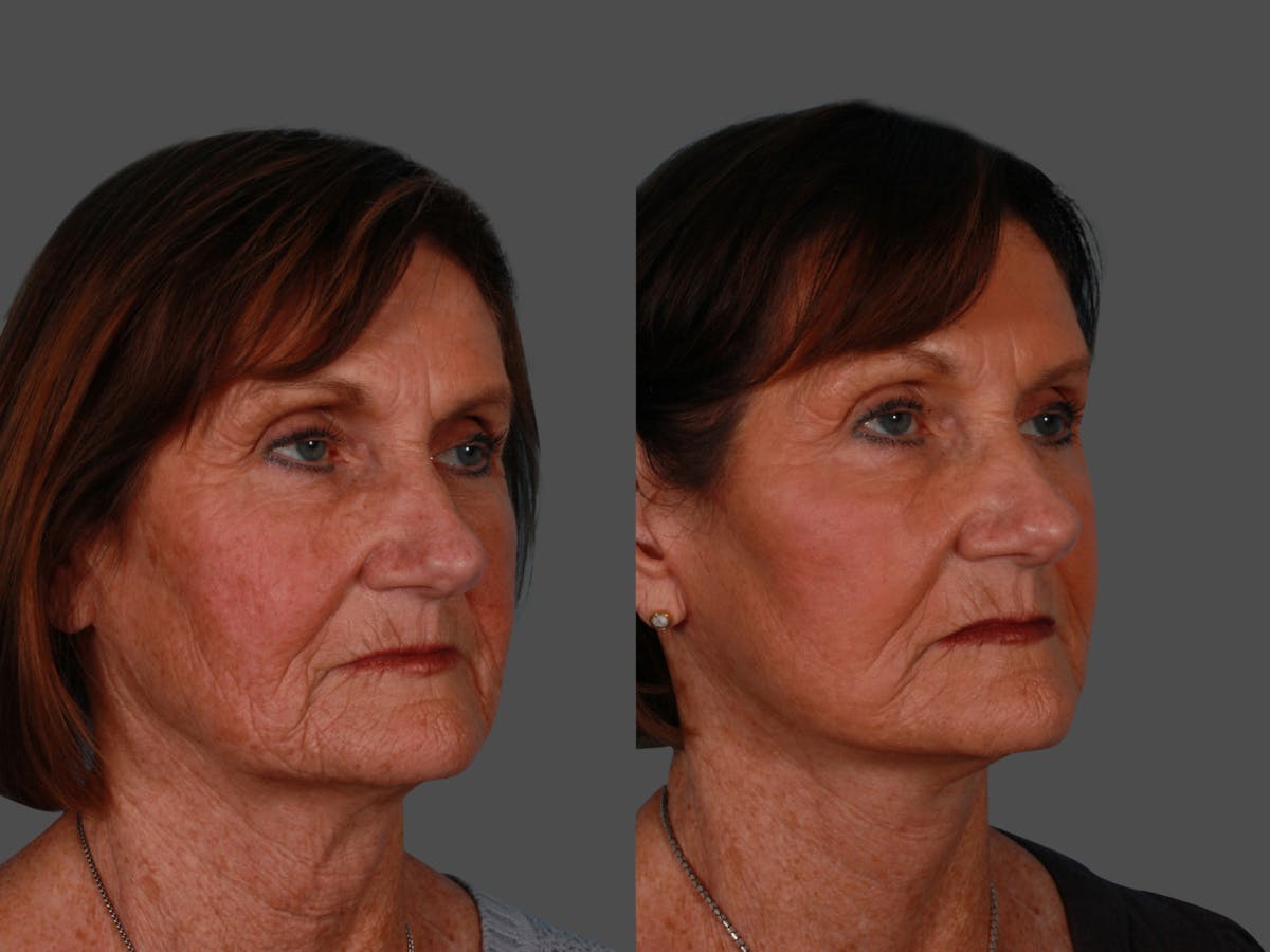 Limited Incision Facelift Before & After Gallery - Patient 583706 - Image 2