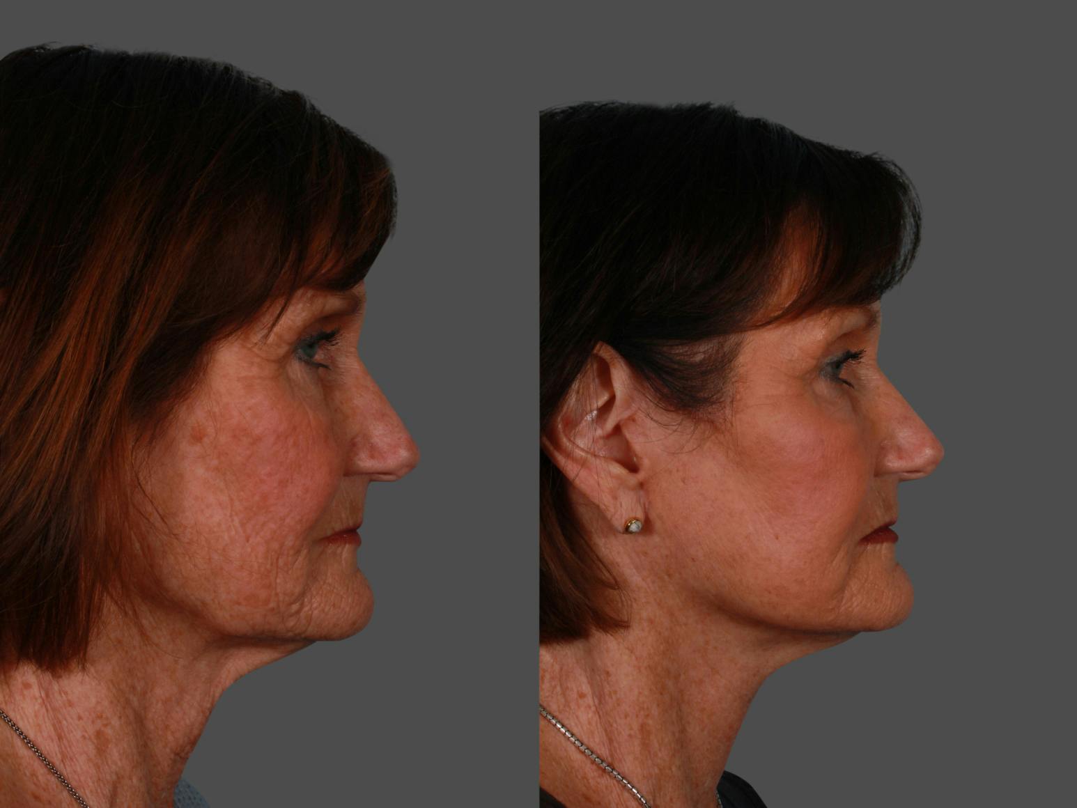 Limited Incision Facelift Before & After Gallery - Patient 583706 - Image 3