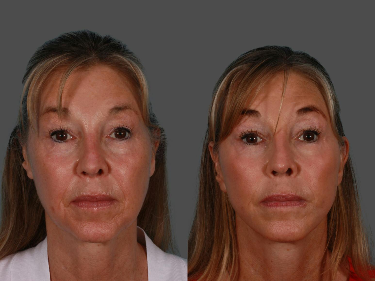 Limited Incision Facelift Before & After Gallery - Patient 289625 - Image 1