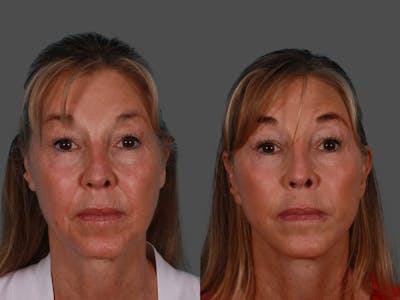 Limited Incision Facelift Before & After Gallery - Patient 289625 - Image 1