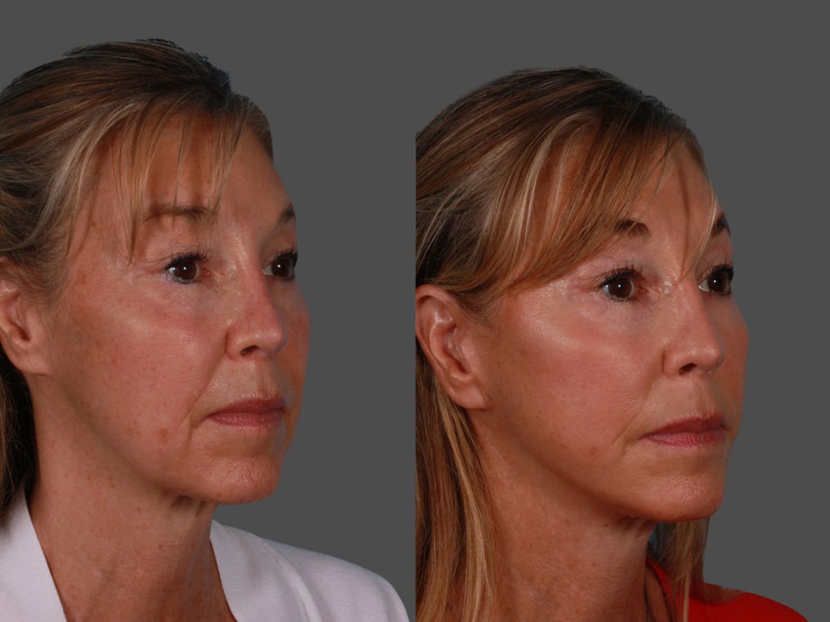 Limited Incision Facelift Before & After Gallery - Patient 289625 - Image 2
