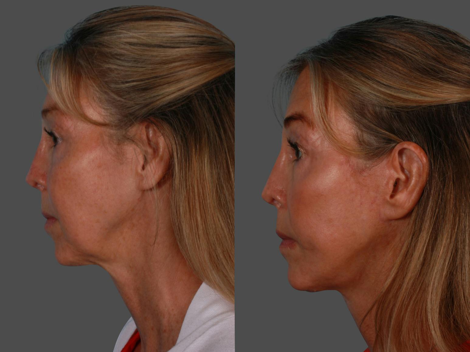 Limited Incision Facelift Before & After Gallery - Patient 289625 - Image 3