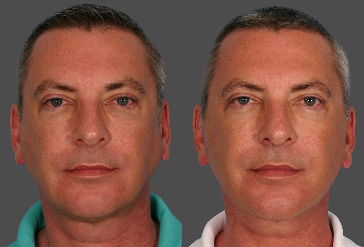 Limited Incision Facelift Before & After Gallery - Patient 302619 - Image 1