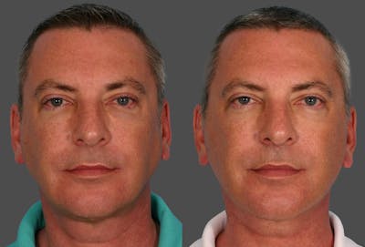 Limited Incision Facelift Before & After Gallery - Patient 302619 - Image 1