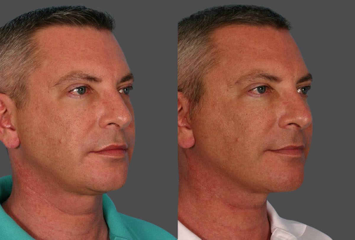 Limited Incision Facelift Before & After Gallery - Patient 302619 - Image 2