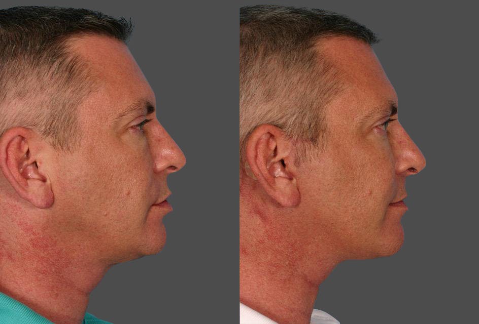 Limited Incision Facelift Before & After Gallery - Patient 302619 - Image 3