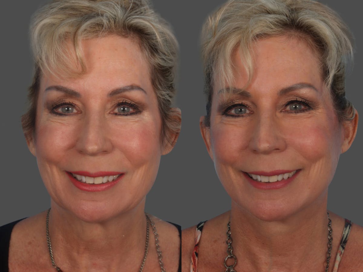 Limited Incision Facelift Before & After Gallery - Patient 363758 - Image 1