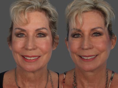 Limited Incision Facelift Before & After Gallery - Patient 363758 - Image 1