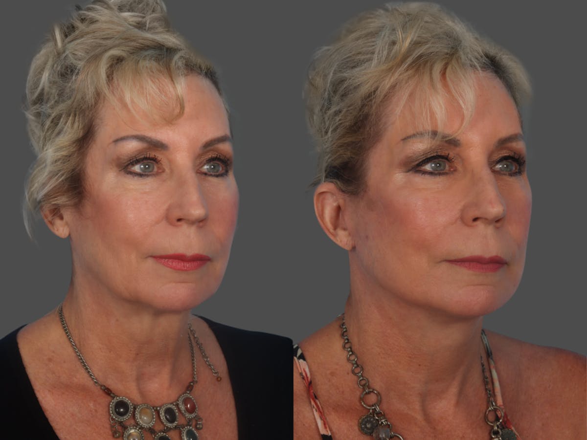 Limited Incision Facelift Before & After Gallery - Patient 363758 - Image 2