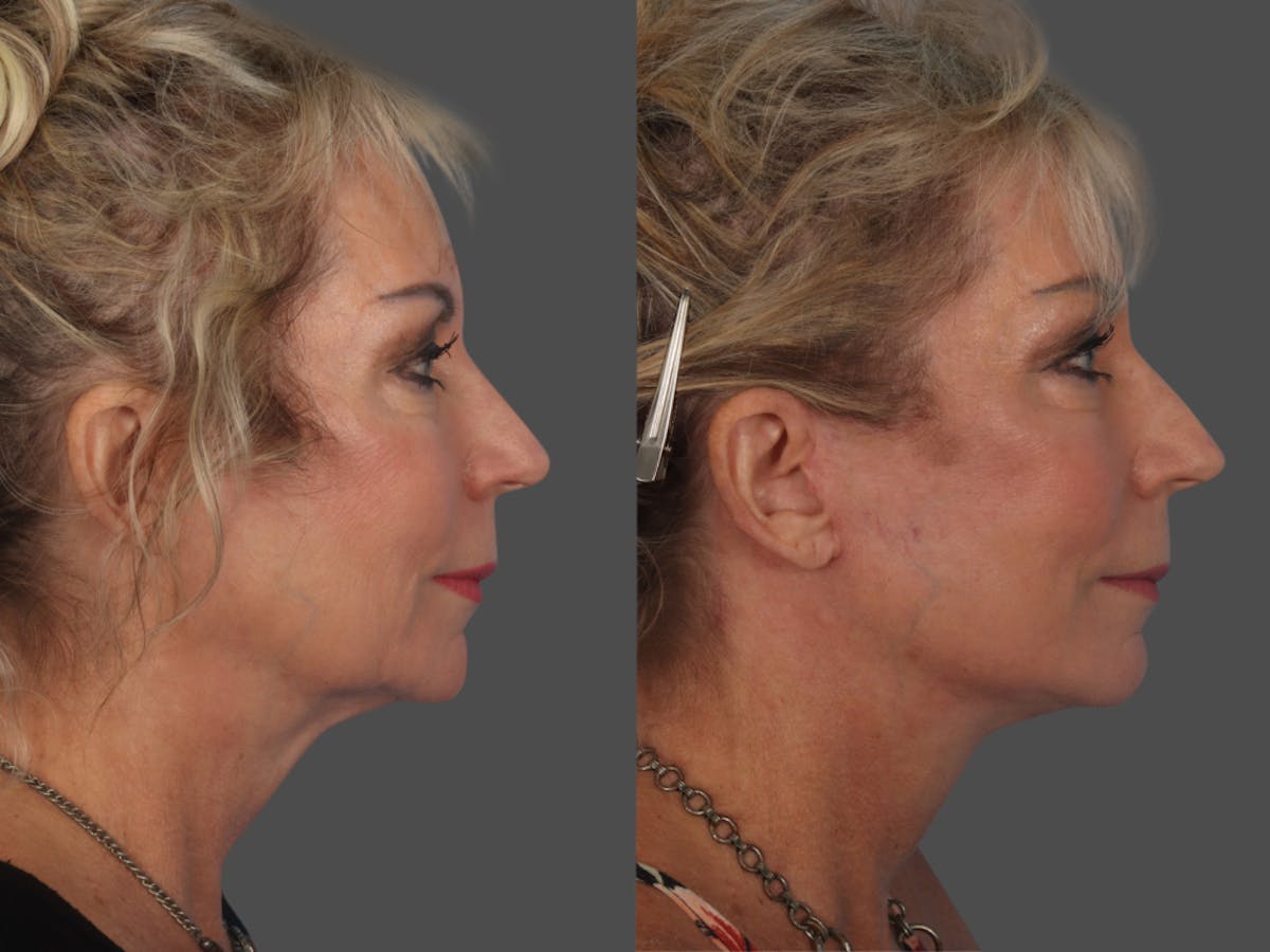 Limited Incision Facelift Before & After Gallery - Patient 363758 - Image 3