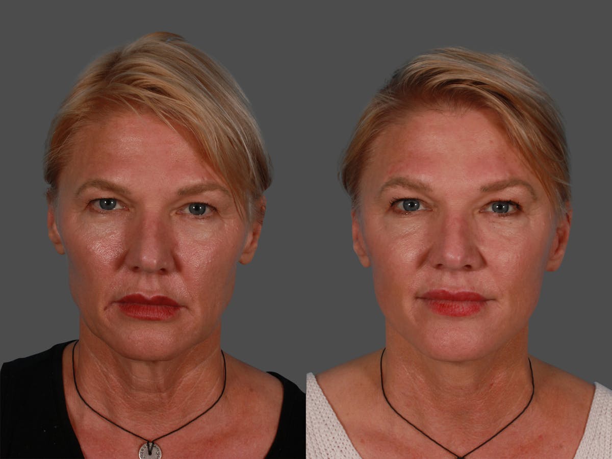 Limited Incision Facelift Before & After Gallery - Patient 222585 - Image 1
