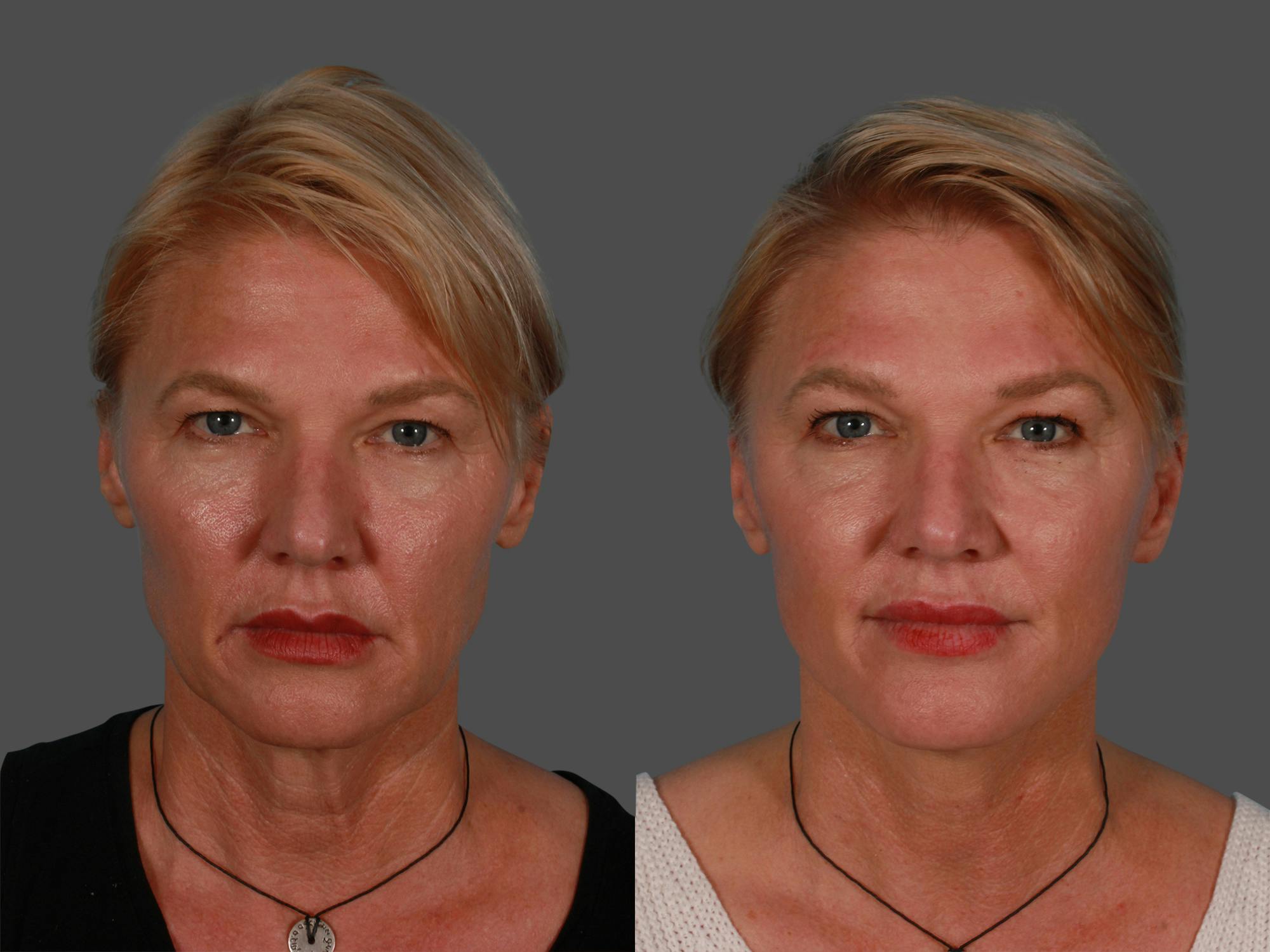 Limited Incision Facelift Before & After Gallery - Patient 222585 - Image 1