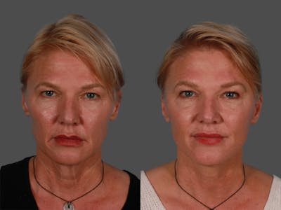 Limited Incision Facelift Before & After Gallery - Patient 222585 - Image 1
