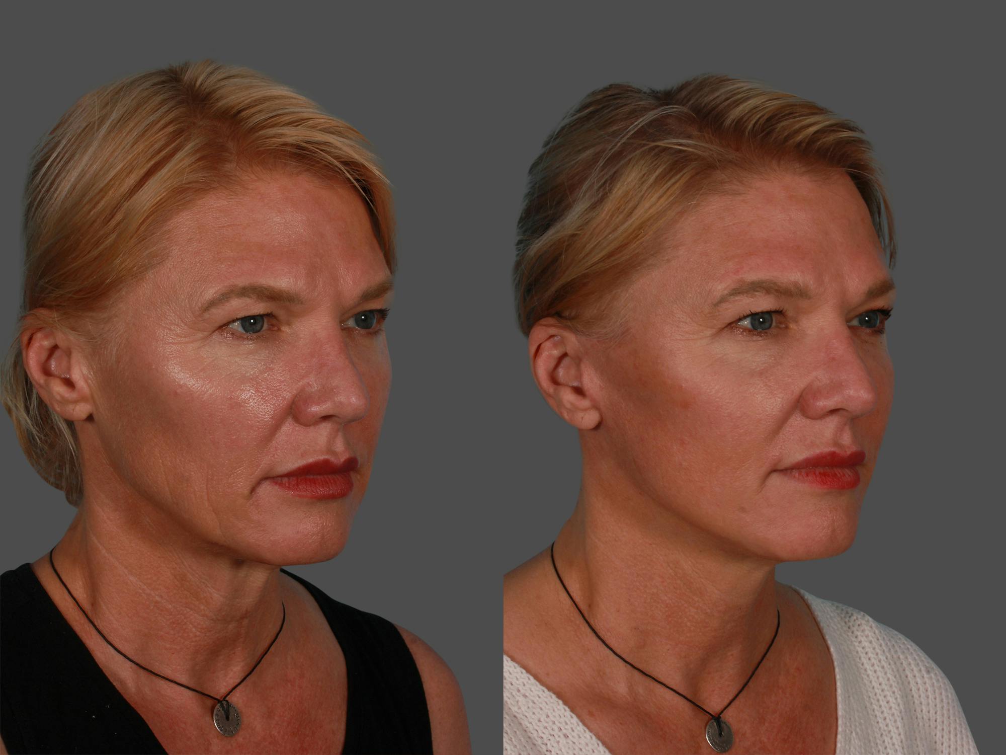 Limited Incision Facelift Before & After Gallery - Patient 222585 - Image 2