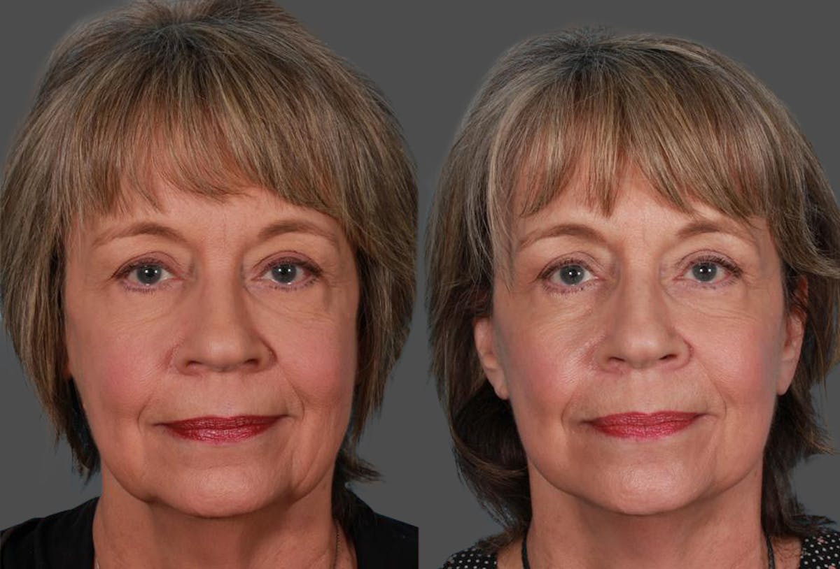 Limited Incision Facelift Before & After Gallery - Patient 742197 - Image 1
