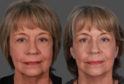 Limited Incision Facelift Before & After Gallery - Patient 742197 - Image 1