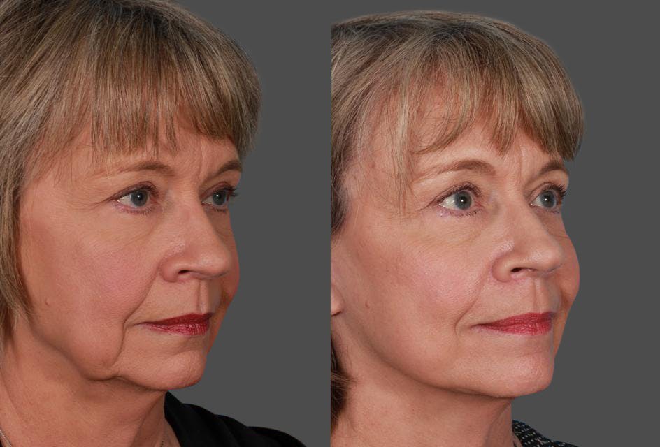 Limited Incision Facelift Before & After Gallery - Patient 742197 - Image 2