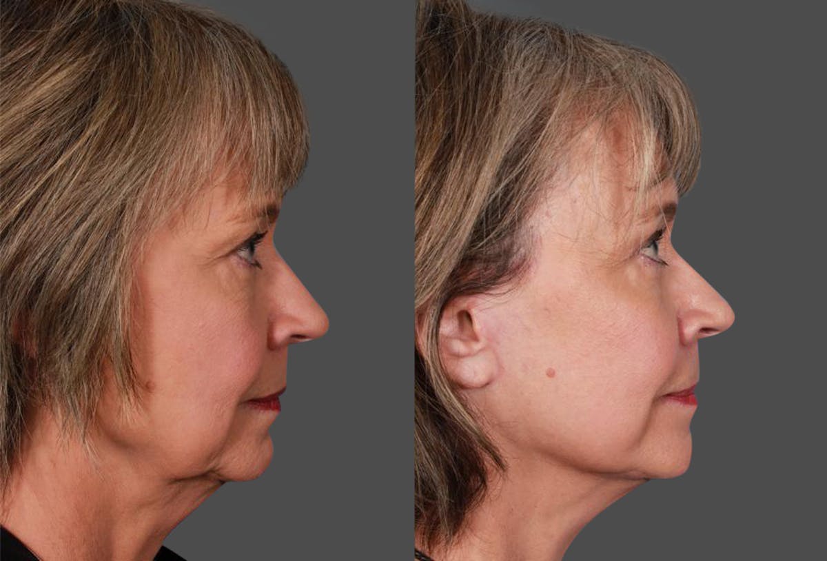 Limited Incision Facelift Before & After Gallery - Patient 742197 - Image 3