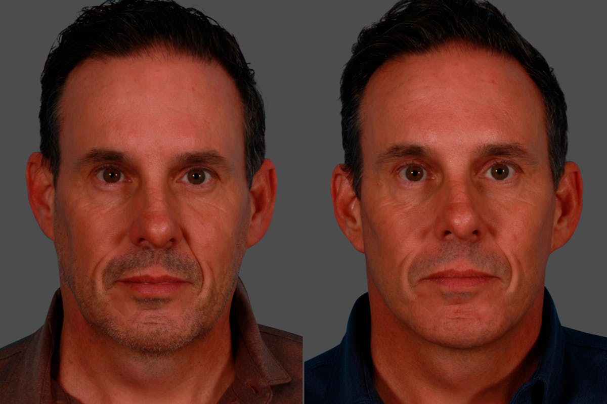 Limited Incision Facelift Before & After Gallery - Patient 621224 - Image 1