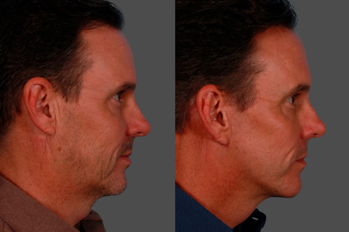 Limited Incision Facelift Before & After Gallery - Patient 621224 - Image 2