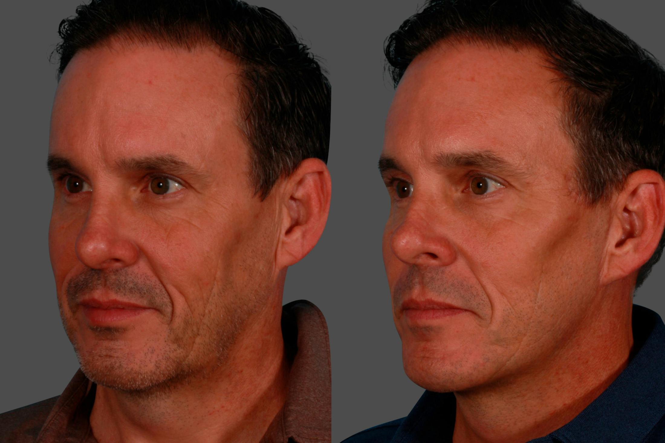 Limited Incision Facelift Before & After Gallery - Patient 621224 - Image 3