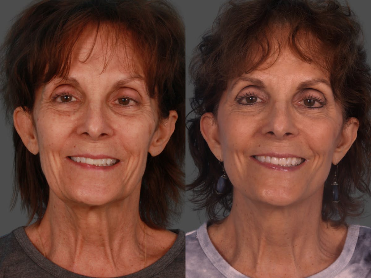 Limited Incision Facelift Before & After Gallery - Patient 307006 - Image 1