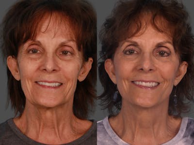 Limited Incision Facelift Before & After Gallery - Patient 307006 - Image 1