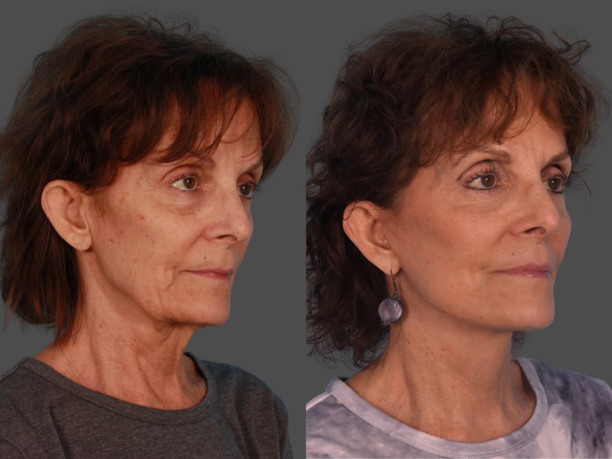 Limited Incision Facelift Before & After Gallery - Patient 307006 - Image 2